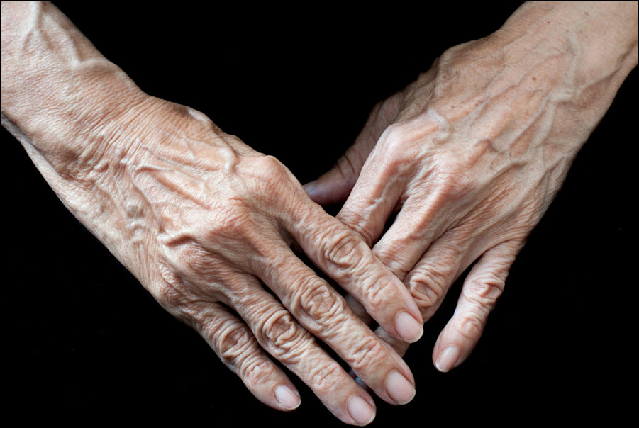 Arthritis